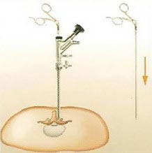 ενδοσκόπιο σπονδυλικής στήλης (interlaminar προσπέλαση)