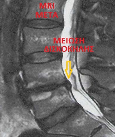 MRI μετά την επέμβαση