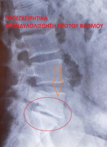 Προεγχειρητικά: Σπονδυλολίσθηση πρώτου βαθμού