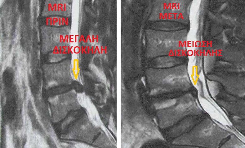 Μείωση δισκοκήλης (Ο4-Ο5) μετά από έγχυση ενδοδισκικής γέλης (Absolute Gel)