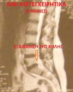 Μαγνητική Διατρηματική Δισκοπλαστική