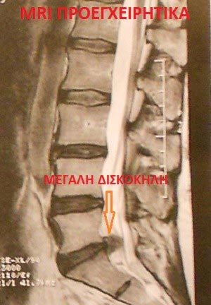 Μαγνητική Διατρηματική Δισκοπλαστική